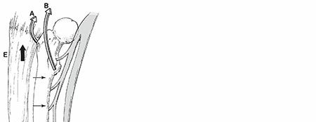 Understanding Femoral Shaft Fractures: From Epidemiology to Treatment