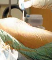 Illustration 25 for Knee Arthroplasty Unicondylar: Discover if Partial Knee Replacement is Right