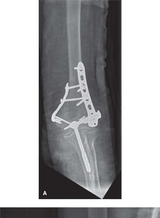 Illustration 5 for Mastering Distal Humerus Fractures: Diagnosis & Treatment