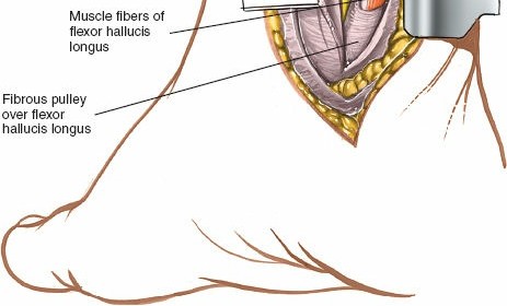 Illustration 22 for Step-by-Step Medial Side of the Ankle Approach Guide