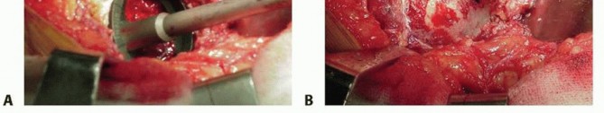 Illustration 10 for Cemented Total Hip: A Successful & Evidence-Based Solution