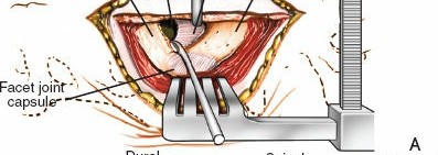 Illustration 15 for Approach to the Lumbar Spine: Mastering Techniques & Anatomy