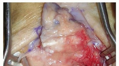 Proximal Row Carpectomy