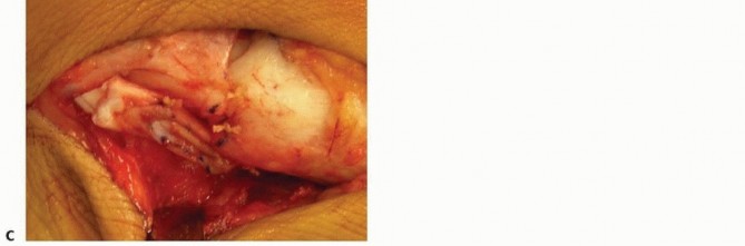 Illustration 19 for Calcaneal Lengthening Osteotomy: Correcting Hindfoot Valgus