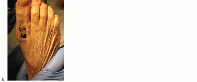 Illustration 72 for End Articular Cartilage Loss: Arthrosurface HemiCAP Resurfacing