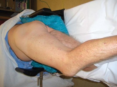 Illustration 43 for Successful Total Hip Replacement in Developmental Dysplasia