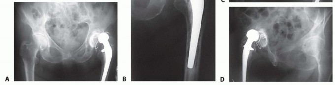 Illustration 2 for Hip Reimplantation Surgery: The Solution for Infected Implants