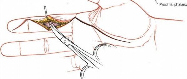 Illustration 148 for Essential Surgical Approaches: Uncover Every Aspect of the Wrist