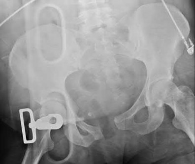 Illustration 129 for OrthoCash: Trauma MCQs & Cases for a yearold woman