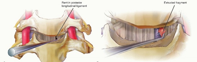 Illustration 16 for How ACDF Clears Your Posterior Disc Space for Lasting Relief