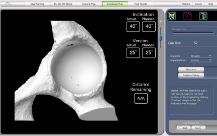 Illustration 34 for Robotics in Total Hip Arthroplasty: A New Era of Precision