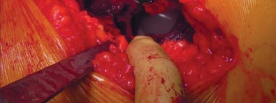 Illustration 23 for Unlock better THA: The technique of short stem for less invasiveness