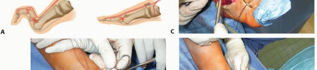 Illustration 46 for How Achilles Tendon Lengthening Fixes Equinocavovarus Foot
