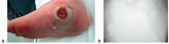 Illustration 13 for Regain Mobility: Surgical Solutions for Charcot Foot Arthropathy