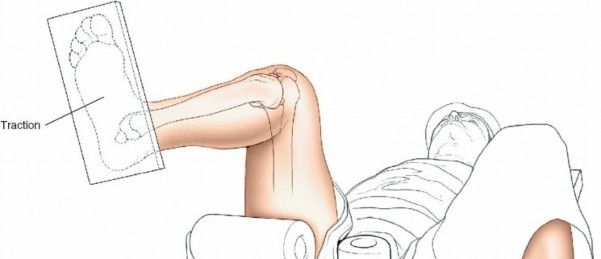 Illustration of approach for tibial - Dr. Mohammed Hutaif