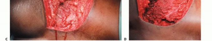 Illustration 28 for Pelvic Metastasis Surgery: A Component of the Utilitarian Approach