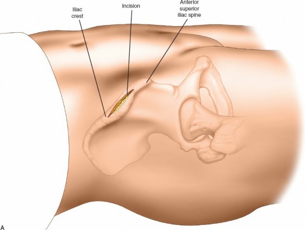 Illustration of external fixation pelvisfemurtibia - Dr. Mohammed Hutaif