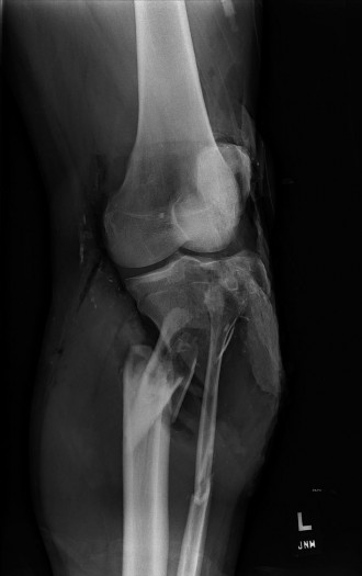 Complex Case Open Fractures: Salvage vs. Amputation