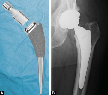 Illustration 14 for Kinectiv® Stem: Modular Necks for Primary THA Success