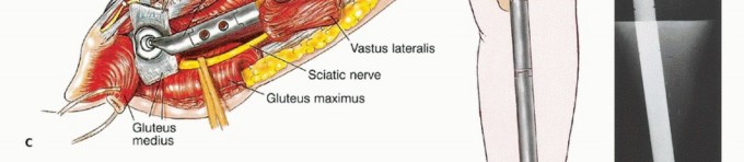 Illustration 38 for Beyond Amputation: Total Femur Resection with Endoprosthetics