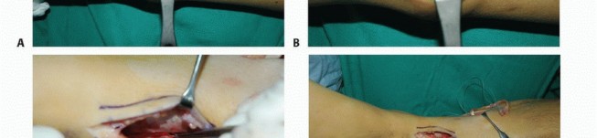 Illustration 44 for Foot Drop Surgery: How a Pin or Drill Elevates Tendon Transfer