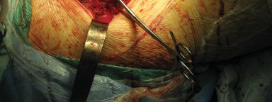 Illustration 68 for Figure Hip Resurfacing: Who Benefits and Who Should Avoid It?