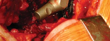 Illustration 25 for S-ROM: Inside the Technique of Modular Implant Design