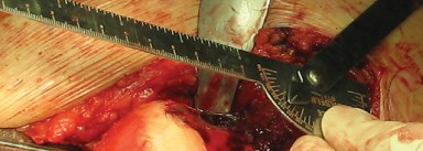 Illustration 38 for Figure Hip Resurfacing: Who Benefits and Who Should Avoid It?