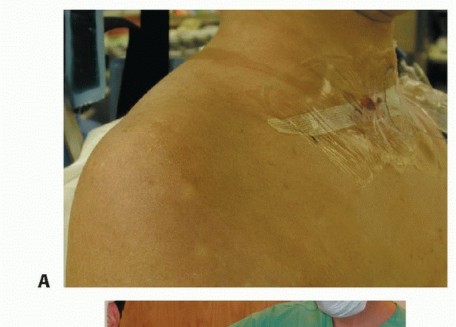 Illustration 5 for Stiff Shoulder? Discover Arthroscopic Capsular Release Solutions