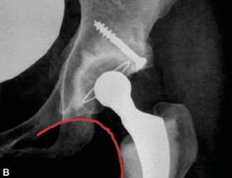 Illustration 32 for Optimizing Acetabular Component Cementation for Superior Outcomes