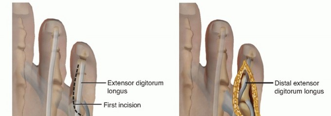 Illustration 28 for Toe Deformity Pain? Rebalance Flexor to Extensor for Relief