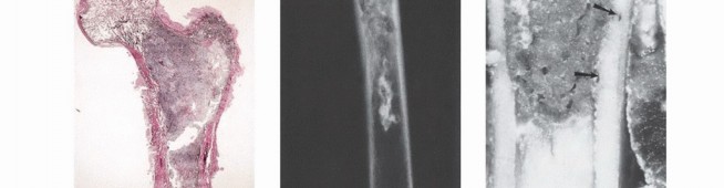 Illustration 49 for Understanding Benign Bone Tumors: Your Complete Preoperative Guide