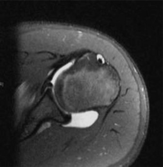 Illustration 2 for Pediatric Anterior Knee Pain: Solve the Puzzle with Case Insights