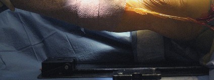 Illustration 23 for Posterior Stabilized Technique: Essential Insights for TKA Success