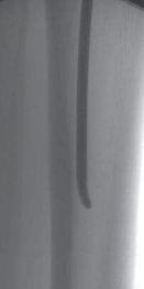 Illustration 17 for Pediatric Tibial Fractures: Avoid Mistakes, Ensure Optimal Healing