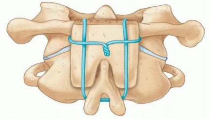 Illustration 29 for Addressing Cervical Spine Instability with Posterior Arthrodesis