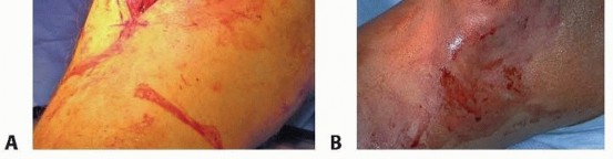 Illustration 22 for Optimizing Intramedullary Nailing for Tibial Shaft Fractures