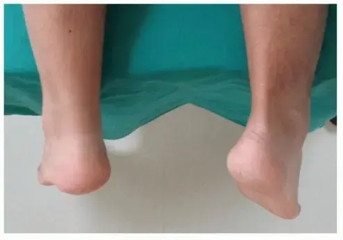 تمزق وتر العرقوب: الدليل الشامل للعلاج والتعافي في اليمن والخليج