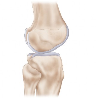 Illustration 17 for Mastering Valgus Total Knee Replacement: Techniques & Pitfalls