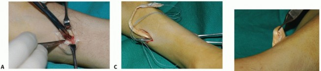 Illustration 11 for Restore Movement: Tendon Transfer for Common Peroneal Nerve Foot Drop