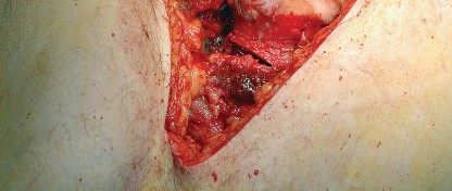 Illustration 34 for Unlock the Figure Posterior Approach to the Hip