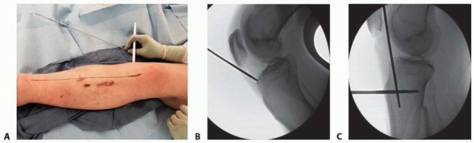 Illustration 26 for Advanced Nailing of the Mature Tibia: Overcoming Complexities