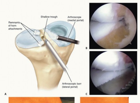Illustration 14 for Symptomatic Knee? Meniscal Transplant for Anterior & Posterior Horns