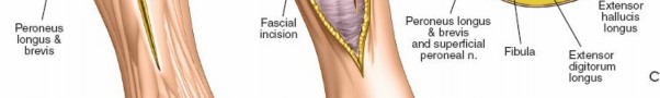 Illustration 111 for Surgical Access: Mastering the Tibia's Surface & Fibula Approaches
