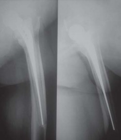 Illustration 76 for S-ROM: Inside the Technique of Modular Implant Design