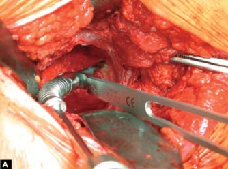 Illustration 9 for Optimizing Acetabular Component Cementation for Superior Outcomes