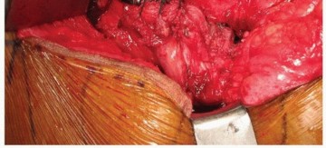 Illustration 34 for Uncemented Acetabular Revision: Optimizing Hemispherical Cup Use