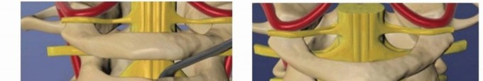 Illustration 20 for Addressing Cervical Spine Instability with Posterior Arthrodesis