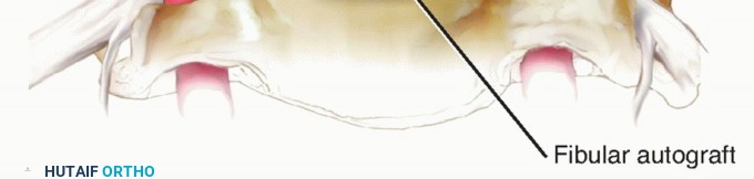 Illustration 19 for Stop Numbness & Instability: Corpectomy and Fusion Guide