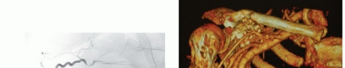 Illustration 18 for Limb-Sparing Resections Around the Shoulder: Optimizing Outcomes